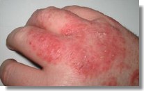 mild eczema